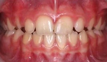Înghesuire dentară → arcade aliniate — după tratament, pacient Family Dental Spa