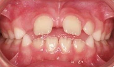 Înghesuire dentară → arcade aliniate — înainte de tratament, pacient Family Dental Spa