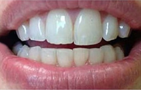 Dinți rotați și spații → linie dentară uniformă — după tratament, pacient Family Dental Spa