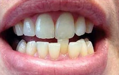 Dinți rotați și spații → linie dentară uniformă — înainte de tratament, pacient Family Dental Spa