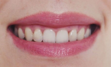 Zâmbet cu spații → dinți aliniați — după tratament, pacient Family Dental Spa