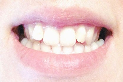 Zâmbet cu spații → dinți aliniați — înainte de tratament, pacient Family Dental Spa