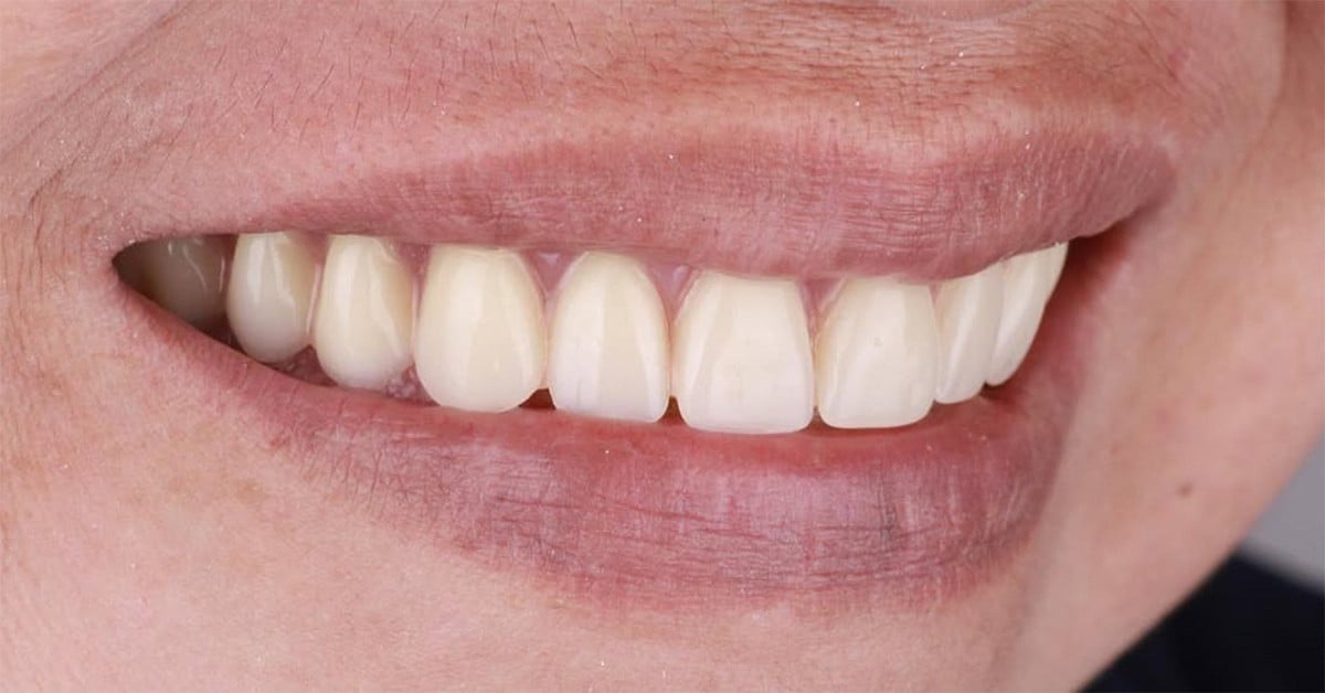 Arcadă superioară fără dinți → dantură fixă — după tratament, pacient Family Dental Spa