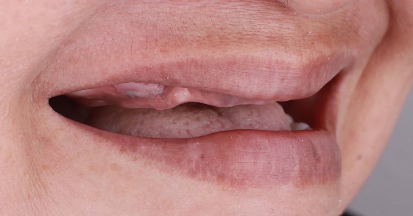 Arcadă superioară fără dinți → dantură fixă — înainte de tratament, pacient Family Dental Spa