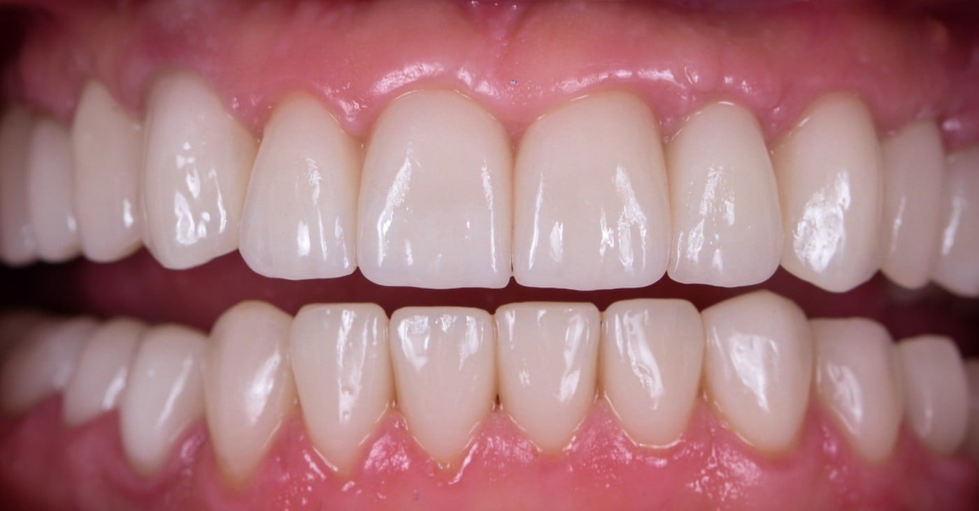 Uzură avansată pe ambele arcade → coroane ceramice — după tratament, pacient Family Dental Spa