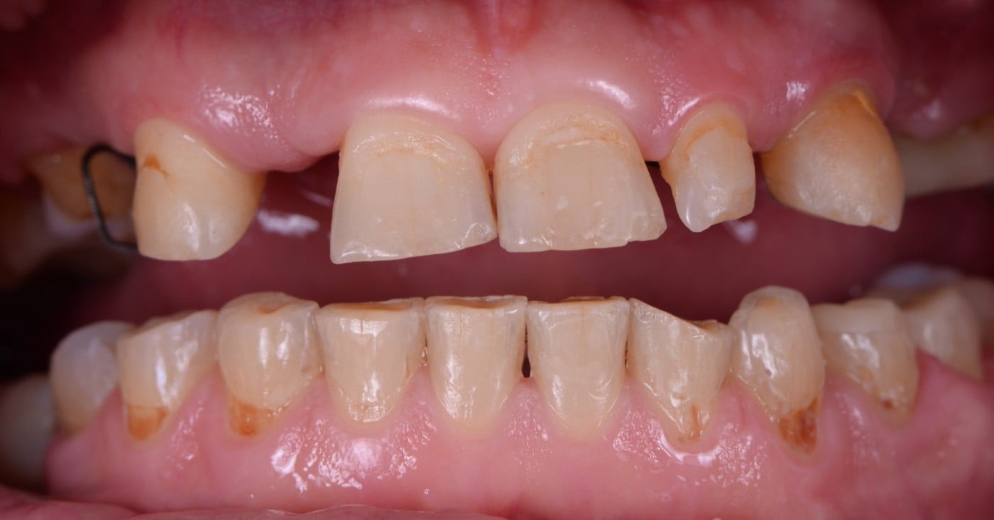 Uzură avansată pe ambele arcade → coroane ceramice — înainte de tratament, pacient Family Dental Spa