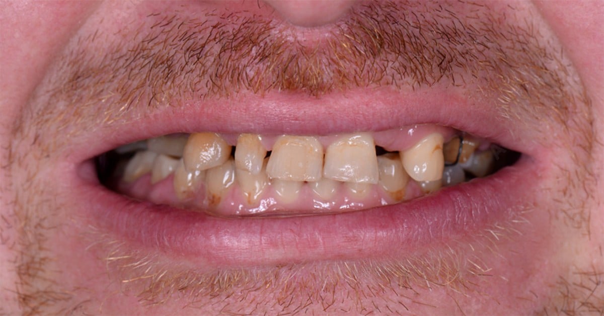 Dinți distruși de carii → ambele arcade refăcute — înainte de tratament, pacient Family Dental Spa