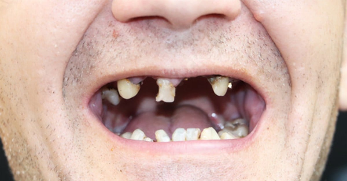 Edentație întinsă → dinți ficși la maxilar — înainte de tratament, pacient Family Dental Spa