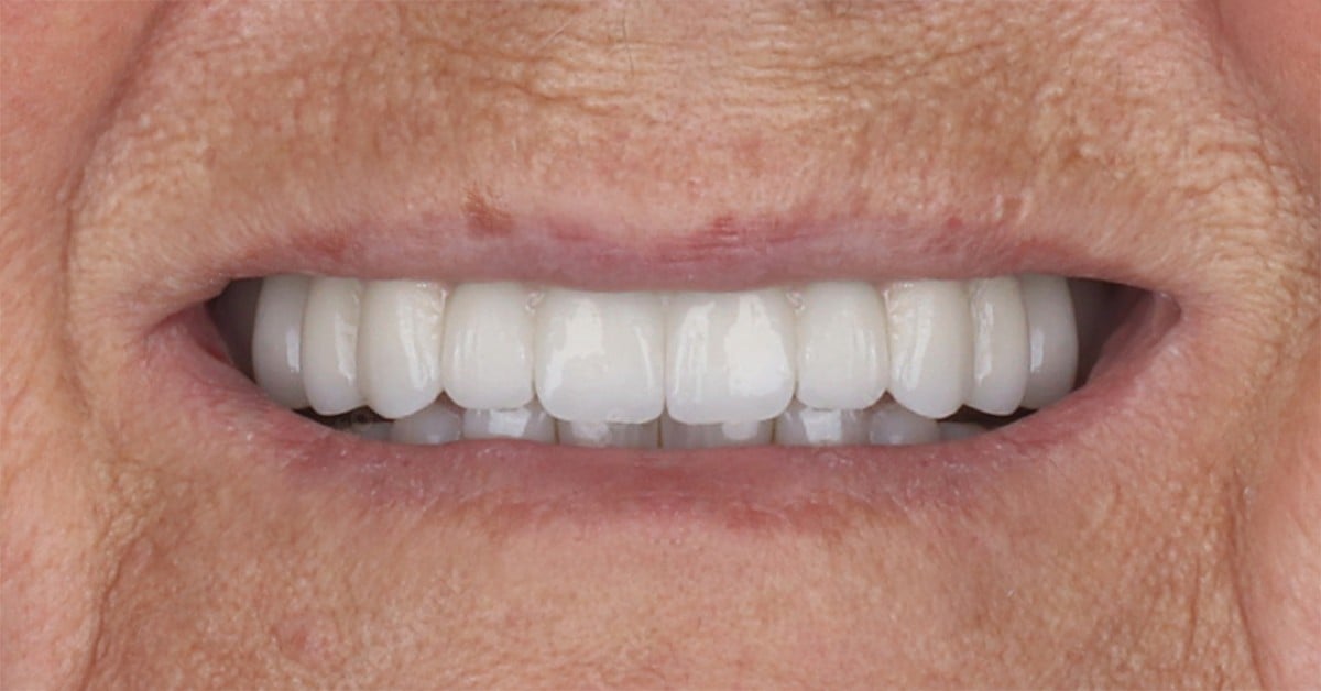 Resturi radiculare și dinți lipsă → arcadă fixă — după tratament, pacient Family Dental Spa