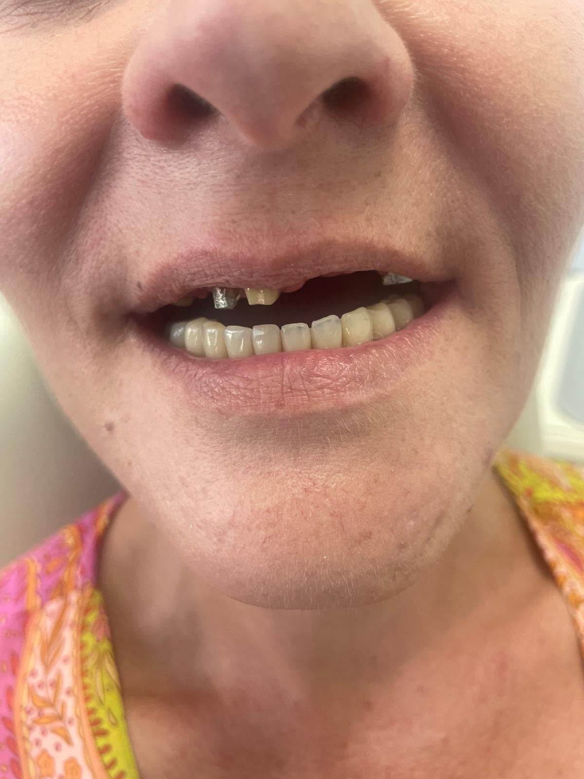 Pacientă cu dinți lipsă, înainte de tratamentul cu implanturi dentare