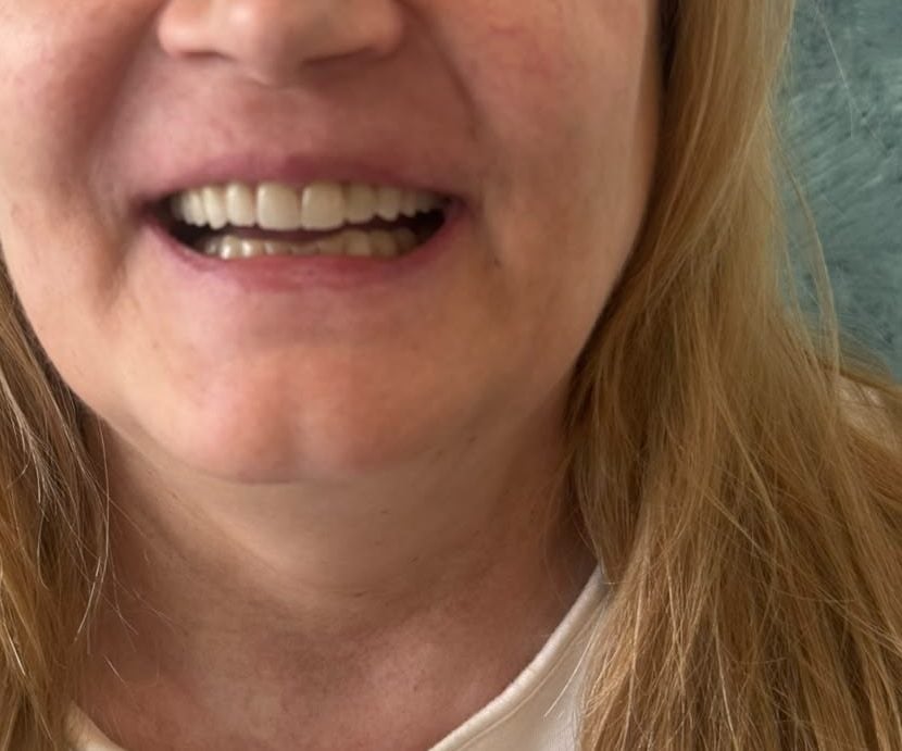 Coroanele din ceramică presată văzute frontal, la zâmbet