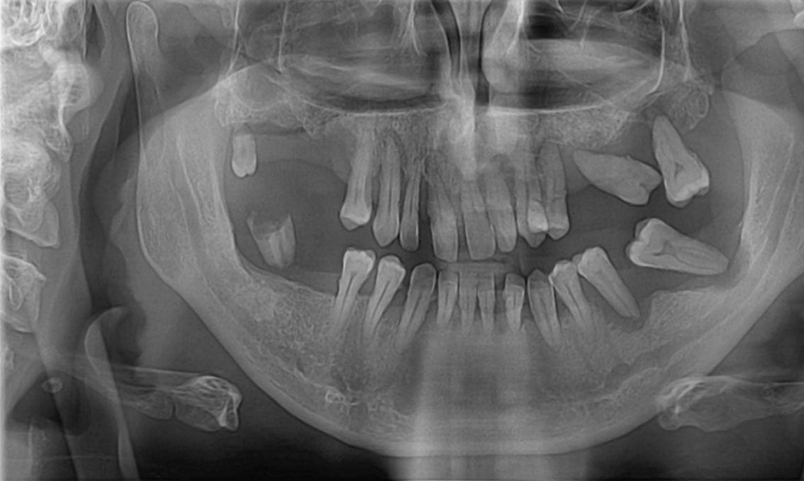 Radiografie panoramică dinaintea tratamentului, cu dentiția restantă pe ambele arcade
