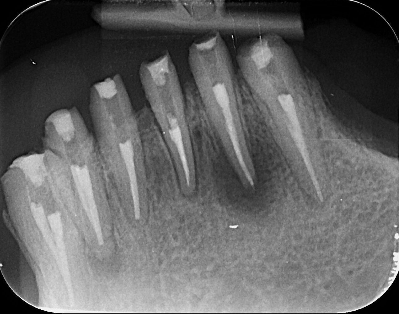 Radiografie a zonei caninului inferior stâng după retratament, cu canalele obturate