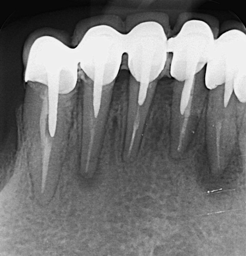 Radiografie a dinților frontali inferiori cu puntea veche și pivoții din rădăcini, partea dreaptă