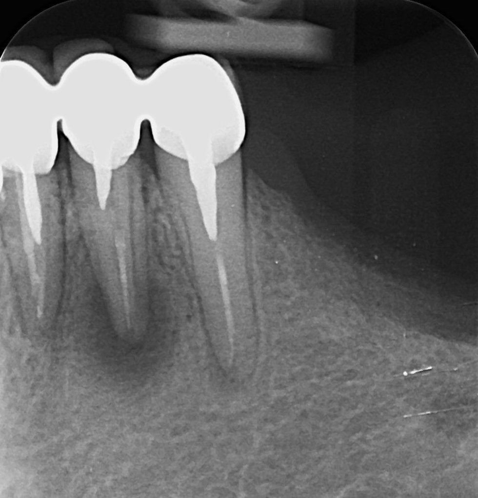 Radiografie a dinților frontali inferiori cu puntea veche și pivoții din rădăcini, partea stângă