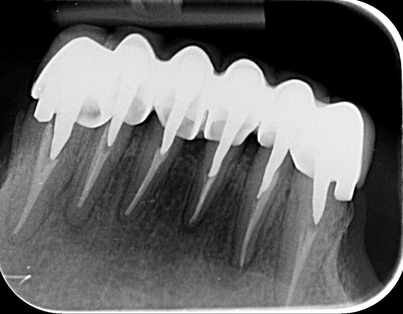 Radiografie a dinților frontali inferiori cu puntea nouă montată pe dinții retratați