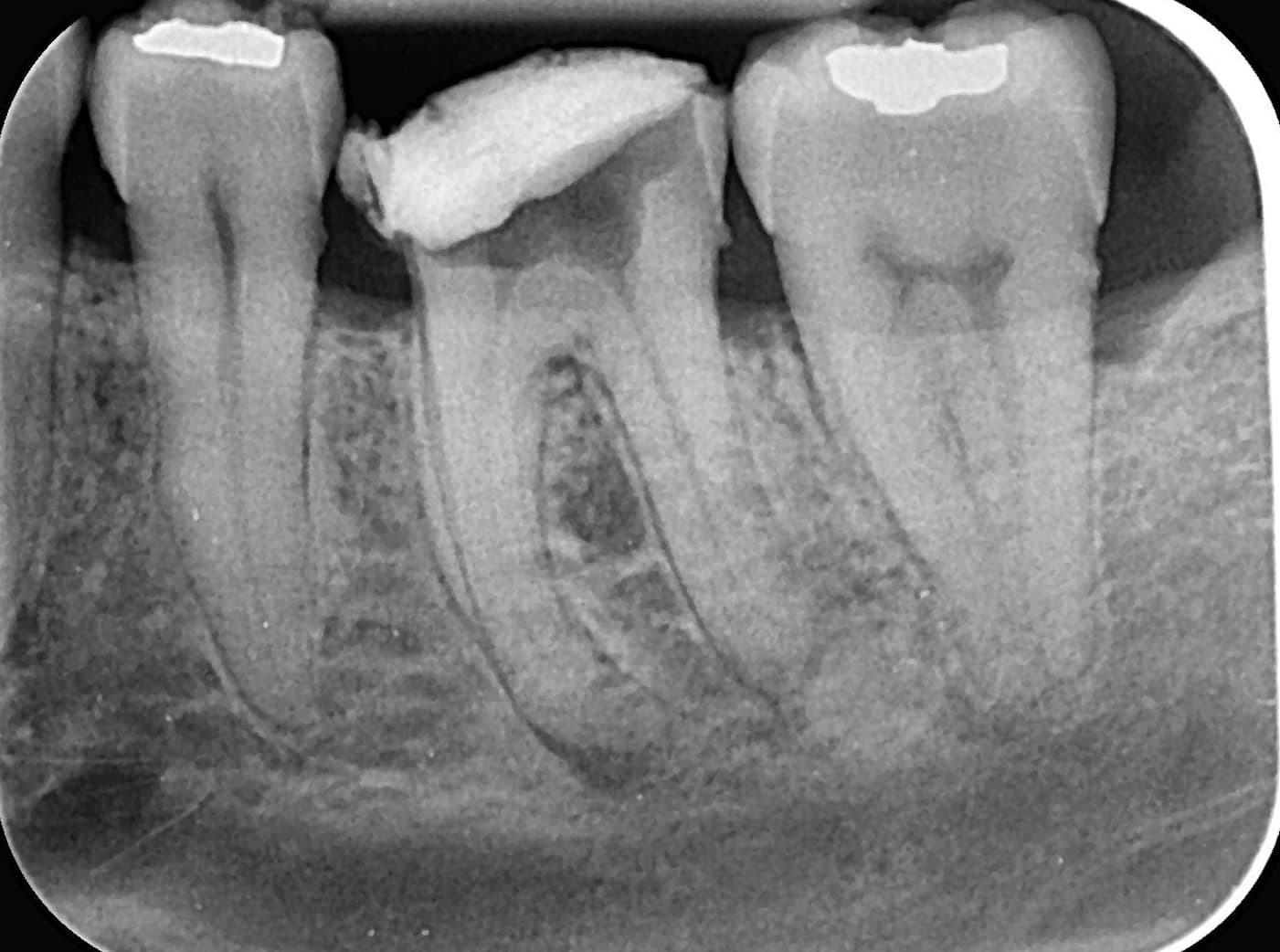 Radiografie a unui molar inferior înainte de tratamentul de canal