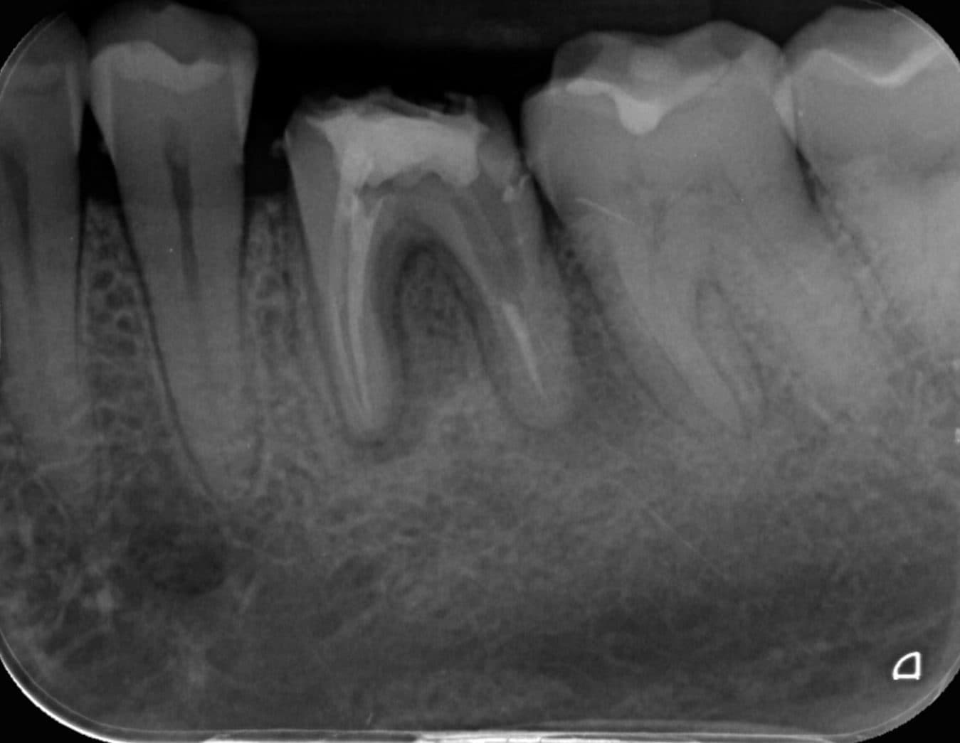 Radiografie a unui molar inferior înainte de tratamentul de canal