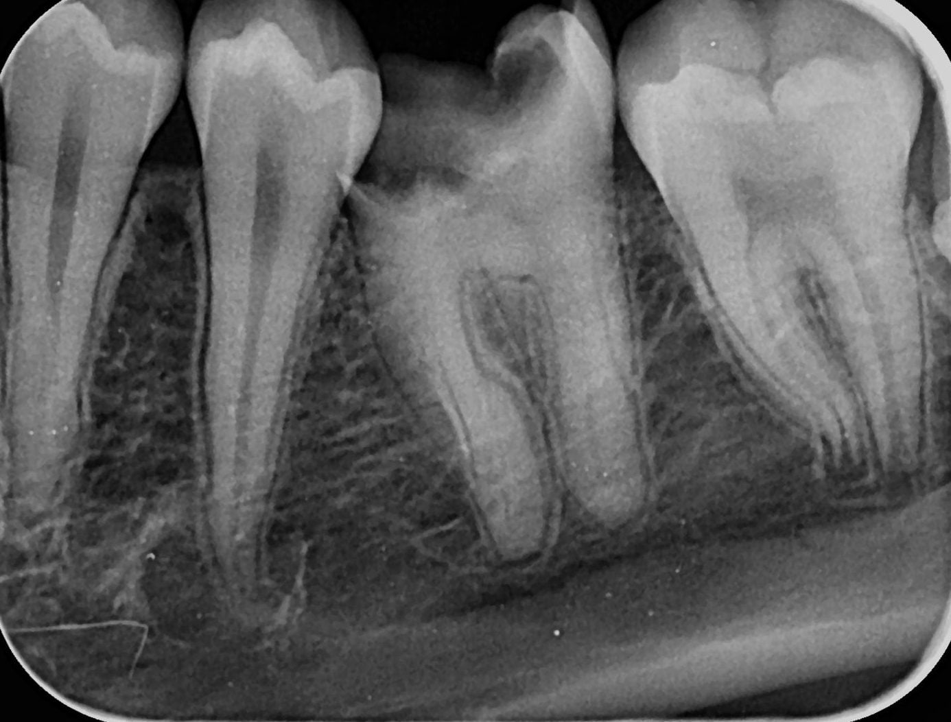 Radiografie a unui molar inferior cu coroana distrusă în mare parte, înainte de tratament