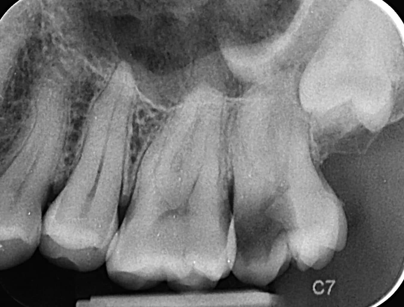 Radiografie a unui molar superior înainte de tratamentul de canal