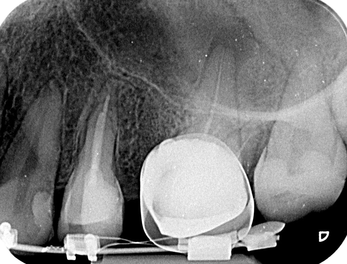 Radiografie a unui molar superior cu matricea montată pentru reconstituire, cu bracketurile aparatului dentar vizibile