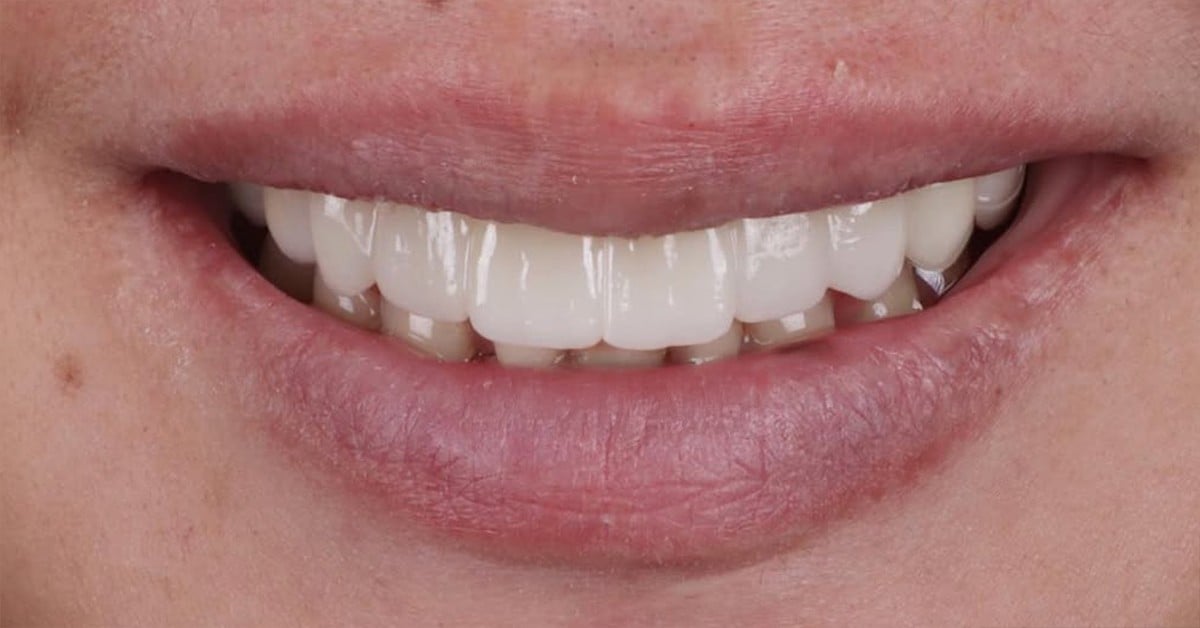 Totul despre fațetele dentare